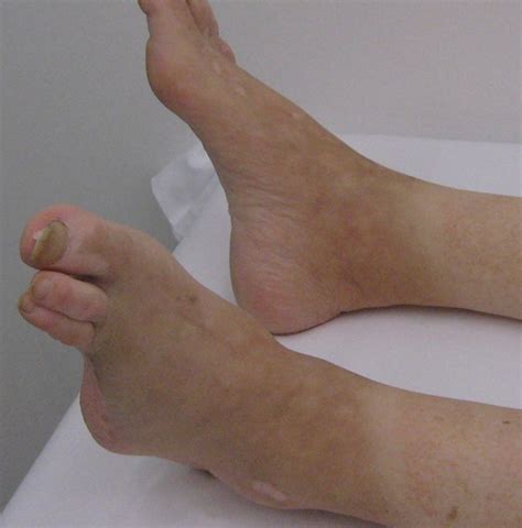 icd 10 code for cellulitis of foot